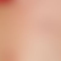 Elastolyse mediodermale: umschriebene, hier markierte flache, weißliche Propulsionen der Haut. Ab...