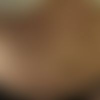 Elastolyse mediodermale: multiple, flache , sympotmlose, knittrige Propulsionen der Haut. Abb. en...