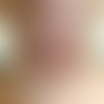 Elastosis perforans serpiginosa:&nbsp;zahlreiche rötliche bis rötlich-bräunliche, randbetonte, sc...