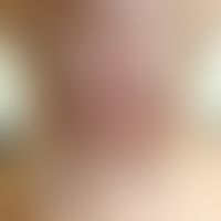 Elastosis perforans serpiginosa:&nbsp;zahlreiche rötliche bis rötlich-bräunliche, randbetonte, sc...