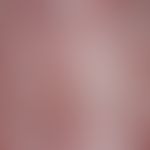 Hyperkeratosis follicularis et parafollicularis in cutem penetrans:&nbsp;ulzerierte Papeln und Kn...
