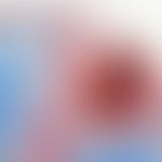 Hyperkeratosis follicularis et parafollicularis in cutem penetrans:&nbsp; angeschnittener Follike...