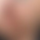 Neuropathisches Ulkus im Gesichtsbereich: pimär verkrustete Stelle mit&nbsp;undefinierbarer Dysäs...