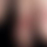 Impetigo contagiosa, großblasige: Sonderform einer großblasigen Impetigo, sog. Bulla repens.
