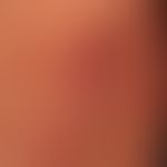 Plaques und Papeln rot und schuppig bei chronisch aktiver&nbsp;Psoriasis vulgaris. Mamillen bleib...