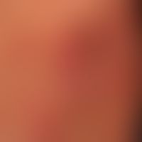 Plaques und Papeln rot und schuppig bei chronisch aktiver&nbsp;Psoriasis vulgaris. Mamillen bleib...