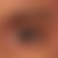 Differenzialdiagnose: Liddermatitis

Diagnose: psoriatischer Befall der Lidregion bei chronisch a...