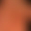 Cheiropompholyx: multiple, akut aufgetretende, juckende Bläschen und Blasen.
