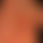 Cheiropompholyx: multiple, akut aufgetretende, juckende Bläschen und Blasen.

