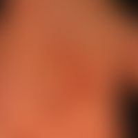 Cheiropompholyx: multiple, akut aufgetretende, juckende Bläschen und Blasen.
