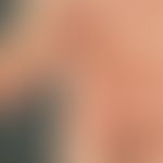 Cheiropompholyx:&nbsp;multiple, akute, an der Handfläche und den Fingerbeugen disseminierte, 0,1-...