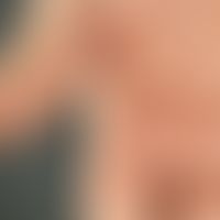 Cheiropompholyx:&nbsp;multiple, akute, an der Handfläche und den Fingerbeugen disseminierte, 0,1-...
