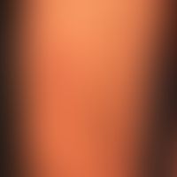 Papel, follikulär: Bakterielle Follikulitis; die roten Knötchenlassen sich eindeutig Follikelstru...