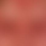 Differenzialdiagnose Angioödem:

Diagnose: Akutes Erysipel (Fieber, Schmerzhaftigkeit, Lymphanden...