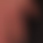 Differenzialdiagnose Erysipeloid

Diagnose: akutes Erysipel;&nbsp;schmerzhafte Schwellung, leicht...