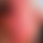 Differenzialdiagnose Leishmaniasis kutane solitäre:

Diagnose: erysipeloide Form der kutanen Leis...