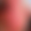 Erysipel-artige kutane Leishmaniasis der Alten Welt. Gut abgrenzbare, wenig schmerzende rote Plaq...