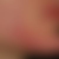 Rosacea conglobata: schwere, therapieresistente, einschmelzende Rosazea.&nbsp;&nbsp;
