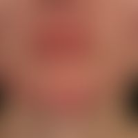 Rosacea conglobata: schwere, therapieresistente, einschmelzende Rosazea.&nbsp;&nbsp;
