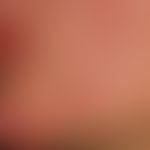 Rosacea conglobata: schwere, therapieresistente, einschmelzende Rosazea.&nbsp;&nbsp;
