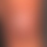 Differenzialdiagnose Narbe: in einer&nbsp;initial atrophisch abgeheilten, reizlosen Narbe Entwick...