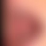 Differenzialdiagnose orale Leukoplakie:&nbsp;weiße Plaques bei Lichen planus exanthematicus.&nbsp...