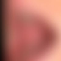 Differenzialdiagnose orale Leukoplakie:&nbsp;weiße Plaques bei Lichen planus exanthematicus.&nbsp...