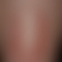 Necrobiosis lipoidica: leicht indurierte Plaque&nbsp;und atrophischer Oberfläche (im Zentrum perg...