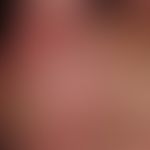 Differenzialdiagnose "Dyshidrotische Dermatitis"

Diagnose: Psoriasis plantaris mit dyshidrotisch...