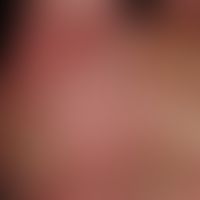 Differenzialdiagnose "Dyshidrotische Dermatitis"

Diagnose: Psoriasis plantaris mit dyshidrotisch...