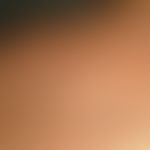 Keloide: bekannte inzwischen abgeheilte Acne vulgaris mit Ausbildung&nbsp;dieser papulösen bzw. k...
