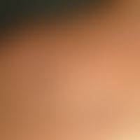 Keloide: bekannte inzwischen abgeheilte Acne vulgaris mit Ausbildung&nbsp;dieser papulösen bzw. k...
