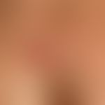 Keloid: wenige Monate&nbsp;altes, druckempfindliches, noch wachsendes&nbsp;Keloid. Vorbekannte &n...