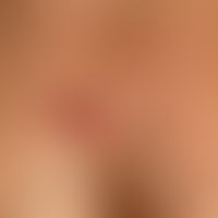 Keloid: wenige Monate&nbsp;altes, druckempfindliches, noch wachsendes&nbsp;Keloid. Vorbekannte &n...