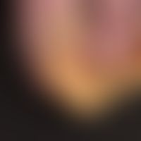 Onychogrypose:&nbsp;krallenartige&nbsp;Wuchsform der Fußnägel bei bekannter Psoriasis vulgaris. E...