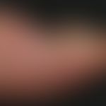 Onychogrypose bei Psoriasis: deutlicher periungualer psoriatischer Befall. Geringes Längen- und v...