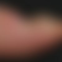 Onychogrypose bei Psoriasis: deutlicher periungualer psoriatischer Befall. Geringes Längen- und v...