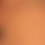 Pityriasis lichenoides chronica:&nbsp;seit&nbsp;mehreren Wochen bestehendes makulopapulöses Exant...