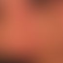 Psoriasis vulgaris chronisch-aktiver Plaque-Typ: seit Monaten permanente Schubaktivität. Überwieg...