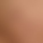 Panniculitis nodularis nonsuppurativa: schubweises Auftreten von druckschmerzhaften, weichen subk...