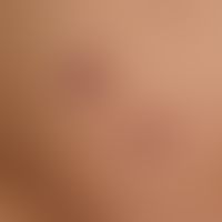 Panniculitis nodularis nonsuppurativa: schubweises Auftreten von druckschmerzhaften, weichen subk...