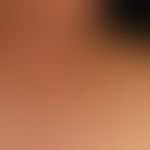 Melanom malignes Typ SSM: seit Jahren bestehende, nur sehr langsam wachsende, völlig beschwerdefr...