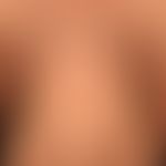Pemphigus vulgaris:&nbsp;multiple, chronische, seit 3 Jahren schubweise verlaufende, symmetrische...