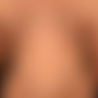 Pemphigus vulgaris:&nbsp;multiple, chronische, seit 3 Jahren schubweise verlaufende, symmetrische...