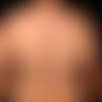 Pemphigus vulgaris:&nbsp;multiple, chronische, seit 3 Jahren schubweise verlaufende, symmetrische...