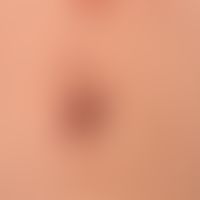 Pemphigus vulgaris: ältere akantholytische Blase mit Resten der Blasendecke.&nbsp;
