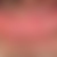 Pemphigus vulgaris: chronisch persistierende, flächenhafte, schmerzhafte Erosionen bei bekanntem ...