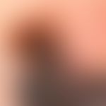 Melanom vom Typ SSM in einer älteren Tätowierung.&nbsp;&nbsp;Auflichtmikroskopie

