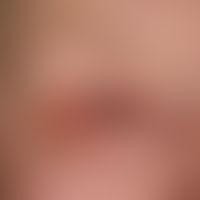 Impetigo contagiosa:&nbsp;nässende, erosive und verkrustete Blepharitis bei immunsuppressiv vorbe...