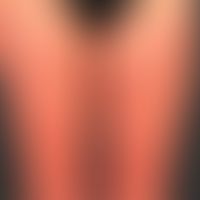 Mastozytose kutane makulopapulöse (Urticaria pigmentosa): etwa 0,5-1,0cm große,&nbsp;disseminiert...